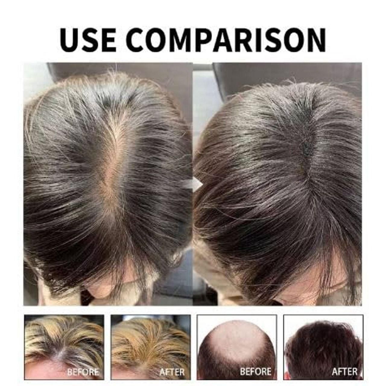 Hair Loss Treatment Serum 30Ml (Pack Of 1)